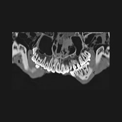 Scanner de la denture de Toutânkhamon - Histoire de la médecine médico-légale